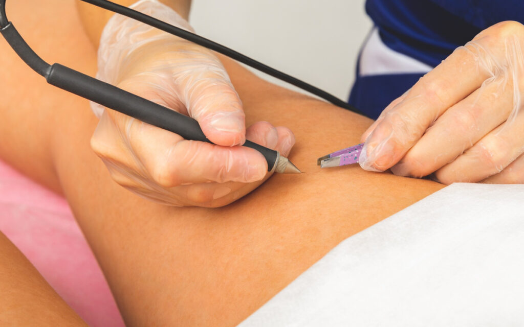 Hatay iğneli epilasyon